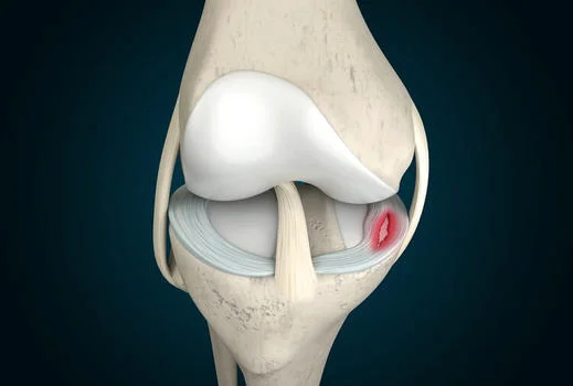 RÁCH SỤN CHÊM KHỚP GỐI ĐIỀU TRỊ NHƯ THẾ NÀO? - Bệnh Viện Thống Nhất