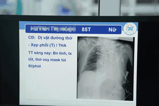 Xep phoi ben trai do di vat duong tho benh nhan H.T.N